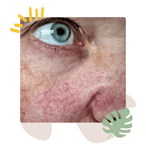 ROSACEA treatment manotick